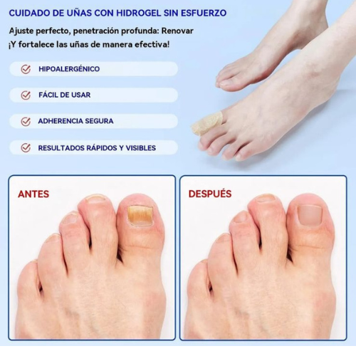 NailClear™ - Parche Antihogo