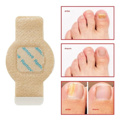 NailClear™ - Parche Antihogo